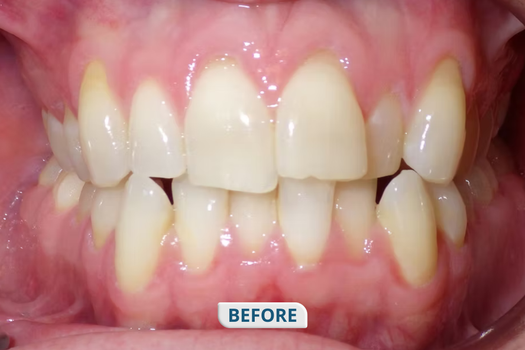Before treatment at Namira Oro Dental Care